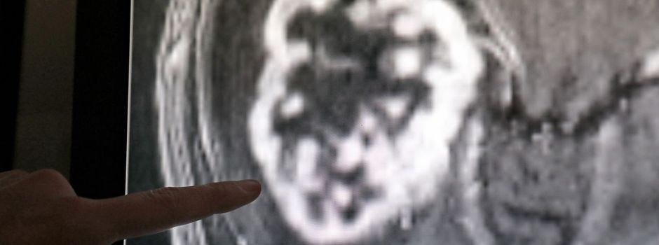 Herzschwäche, Alzheimer, Krebs: microRNA in der Medizin