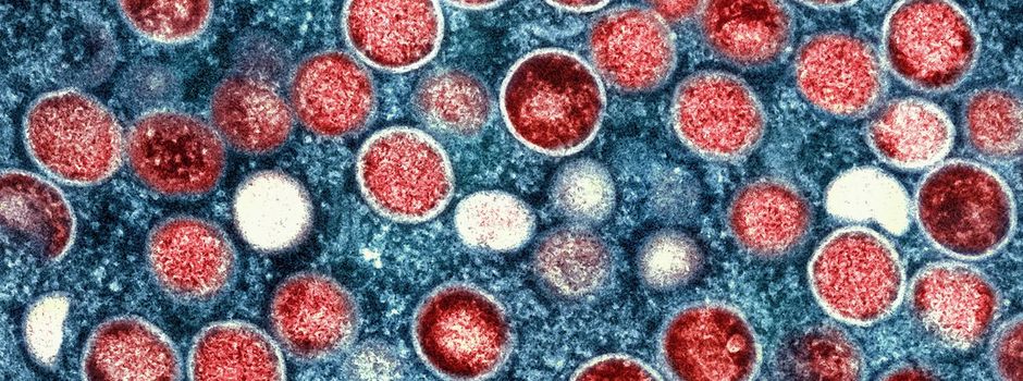 WHO ruft wegen Mpox weltweite Notlage aus