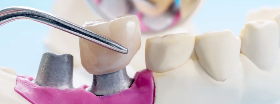 Feste Zähne statt Unsicherheit: So kann der Weg zu Implantaten sanft gelingen