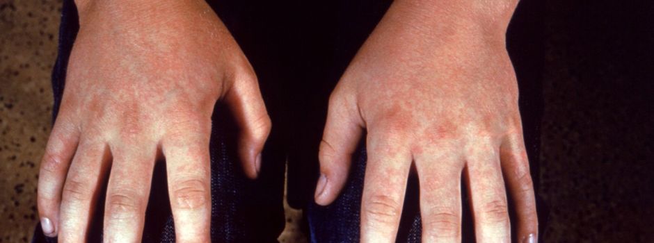 Ringelröteln gehen in Rheinhessen um