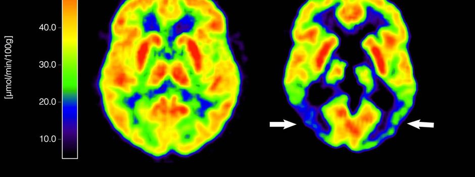 Antikörper Lecanemab: Wie er wirkt und wem er helfen kann